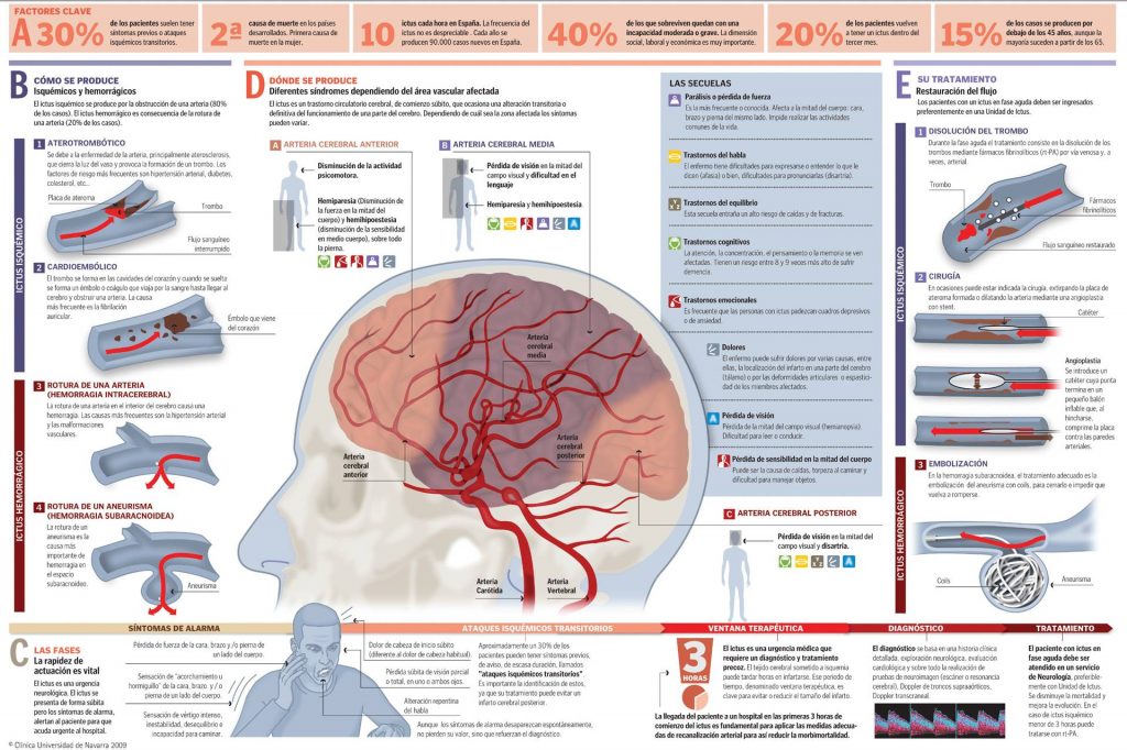 Imagen sobre el accidente cerebrovascular: qué es, cómo se produce, diagnóstico y tratamiento